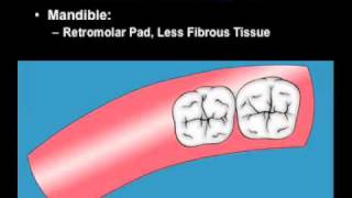 Distal Molar Surgery part 1mov [upl. by Winston]