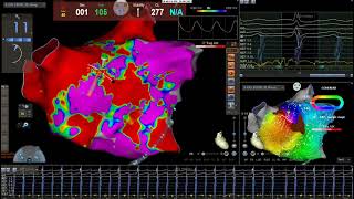 Left atrial flutter ablation par le Dr Franck Halimi Rythmologue Paris [upl. by Alleyne]