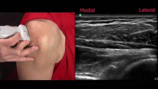 Ultrasound of the Shoulder [upl. by Merdith978]