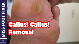 Callus Callus Callus On Foot  Thick Callus Removal From Foot Full Treatment By Miss Foot Fixer [upl. by Kcirb]