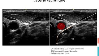 Stellate Ganglion Block [upl. by Takken]