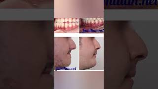 Before and After Orthodontic Treatment dentist bracing music dentalproblem openbite dentistry [upl. by Dinesh]