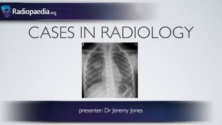 Cases in Radiology Episode 3 pediatric chest xray [upl. by Stefania614]