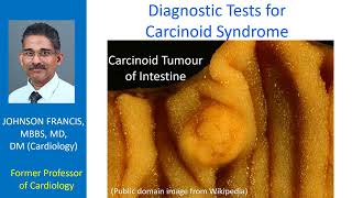 Diagnostic Tests for Carcinoid Syndrome [upl. by Ahsieket]