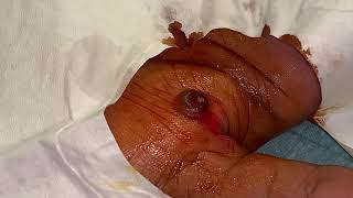 removal of granuloma from a hand [upl. by Ylrrad]