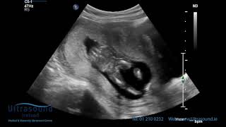 Scan of the Week 15 Weeks Pregnant The Advanced Early Ultrasound [upl. by Bergerac]