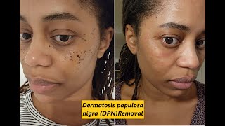 Dermatosis papulosa nigra DPN Removal [upl. by Elbon]