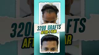 3200 Grafts Hair Transplant  1 Year Result hairtransplant hair shorts ytshorts [upl. by Maryrose]