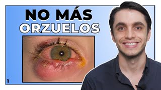 Orzuelos amp Chalaziones 💡 Tratamiento REAL que funciona ¿Cómo Eliminarlos y Prevenirlos [upl. by Hannon81]