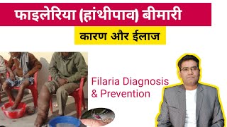 Filaria Cause Symptoms and Treatment  हांथीपाव से बचाव कैसे करें [upl. by Boehike38]