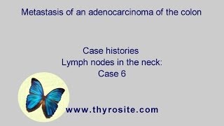 Metastasis of an adenocarcinoma of the colon Lymph nodes in the neck  case 6 [upl. by Imhskal]