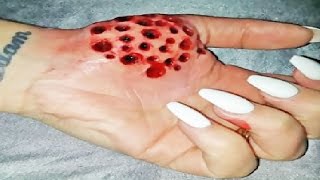 Real Trypophobia Cysts [upl. by Lomasi]