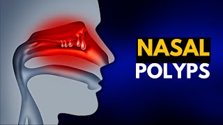 NASAL POLYPS Causes SIgns and Symptoms Diagnosis and Treatment [upl. by Ytiak]