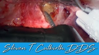 Apicoectomy of Infected Tooth with PRF amp Phlebotomy [upl. by Malcom]