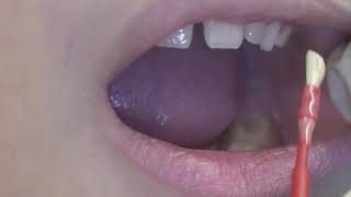 Fluoride Varnish Application [upl. by Ignacia]