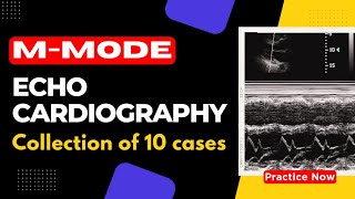 M Mode Echocardiography Cases  Collection of 10 MModes You Must Know [upl. by Aramanta]