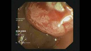 Pancreatic Duct PD Dilatation [upl. by Jamison]