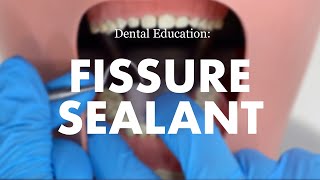 Placement of a Fissure Sealant [upl. by Larrie]