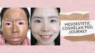 Cosmelan Treatment by Mesoestetic  Removal of Freckles Melasma amp Pigmentation [upl. by Aicirtel958]