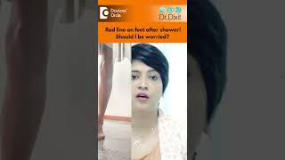 Why Your Feet Are Red after a Hot Shower  Hives coldurticaria Dr Rasya Dixit  Doctors Circle [upl. by Siram855]