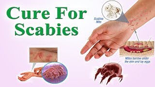 How To Cure Scabies FOREVER  AYURVEDIC TREATMENT [upl. by Reyaht514]