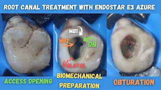 Root Canal Treatment 🟠 Maxillary First Permanent Molar 🔵 Endostar E3 Azure 🟡How to find Mb1 amp Mb2 [upl. by Urquhart]