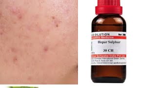 Acne  pimples ko kaise thik kare konsi homoeopathic dawa le  Top 11 homoepathic medicine for acne [upl. by Oihsoy]