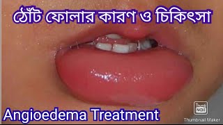 ঠোঁট ফোলার কারণ  ঠোঁট ফোলা কমানোর উপায়  Angioedema Treatment [upl. by Atiana]