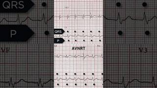 AVNRT ECG Retrograde p waves [upl. by Quincey516]