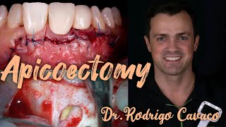 Apicoectomy Surgical method of root canal treatment DrRodrigo Cavaco [upl. by Celestyn]