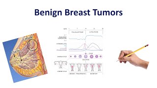 Benign Breast Conditions  USMLE COMLEX NCLEX [upl. by Assirralc554]