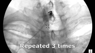 Cervical Interlaminar Epidural Steroid Injection  ThePainSourcecom [upl. by Carissa]