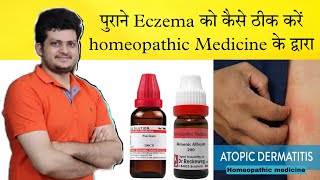 How to Cure Atopic Dermatitis  Homeopathic Medicine  full Treatment amp Precautions [upl. by Ecarg]