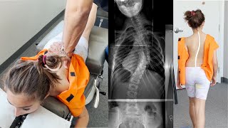 Scoliosis Treatment with Gonstead Chiropractic Care Ep2 Dr Rahim [upl. by Leanatan]