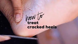 DIY PEDICURE FOR CRACKED HEELS  How to Treat Cracked Heels At Home [upl. by Acinorej]