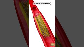 Balloon angioplasty  angioplasty  central vein balloon angioplasty  Angioplasty animation [upl. by Kincaid257]