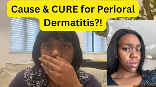 What causes PERIORAL Dermatitis And How to heal it Naturally [upl. by Jewett]