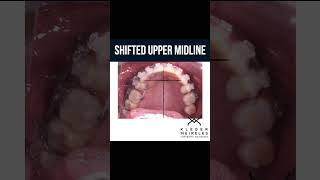 SHIFTED UPPER MIDLINE  ORTHODONTIC TIPS Shorts [upl. by Ellehcit]