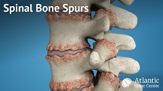 Spinal Bone Spurs [upl. by Hoye921]