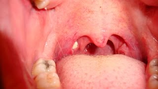 Tonsil Stones  How to Remove Tonsil Stones [upl. by Warp]