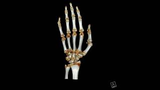 4th and 5th Metacarpal base fracture [upl. by Tehr]