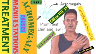 what is acromegaly in Urduacromegaly with English subtitlesAcromegaly in Hindi 2024 [upl. by Hamirak]