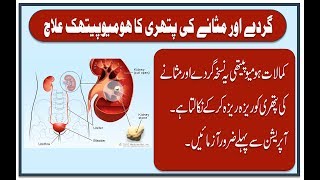 Gurdy or Masany ki pathri ka Homeopathic ilaj  Homeopathic Treatment of Kidney and Bladder Stone [upl. by Corb]