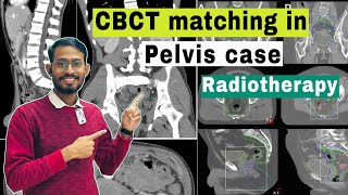 How to match CBCT image in pelvic case  Radiotherapy  Cancer Treatment  sagarshil cancer [upl. by Ennej46]