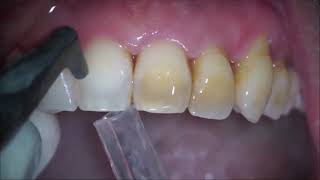 Removing Teeth Stains [upl. by Malena]