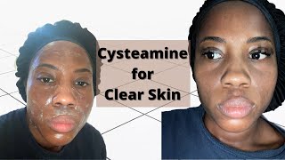 Cysteamine Cream for Clear Skin  Dark Skin [upl. by Zohara]