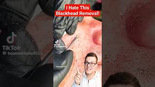 BRUTAL BLACKHEAD REMOVAL  Dont Let Them Do This shorts [upl. by Nisay267]