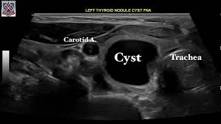 Thyroid cystic nodule treatment by Sean Nikravan MD FACE Thyroid Institute [upl. by Besse]