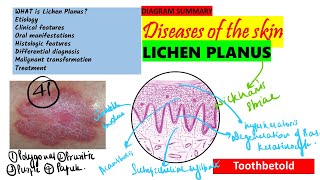 Oral Lichen planus Part 1 Causes Pathogenesis Clinical features Skin lesions [upl. by Anaul]