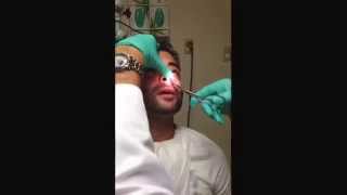 Part 2Nasal Splint Removal quotPULLING OUT WORLDS BIGGEST BOOGERquot WARNING NOT FOR THE SQUEEMISH [upl. by Okun917]